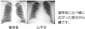 レントゲンの比較